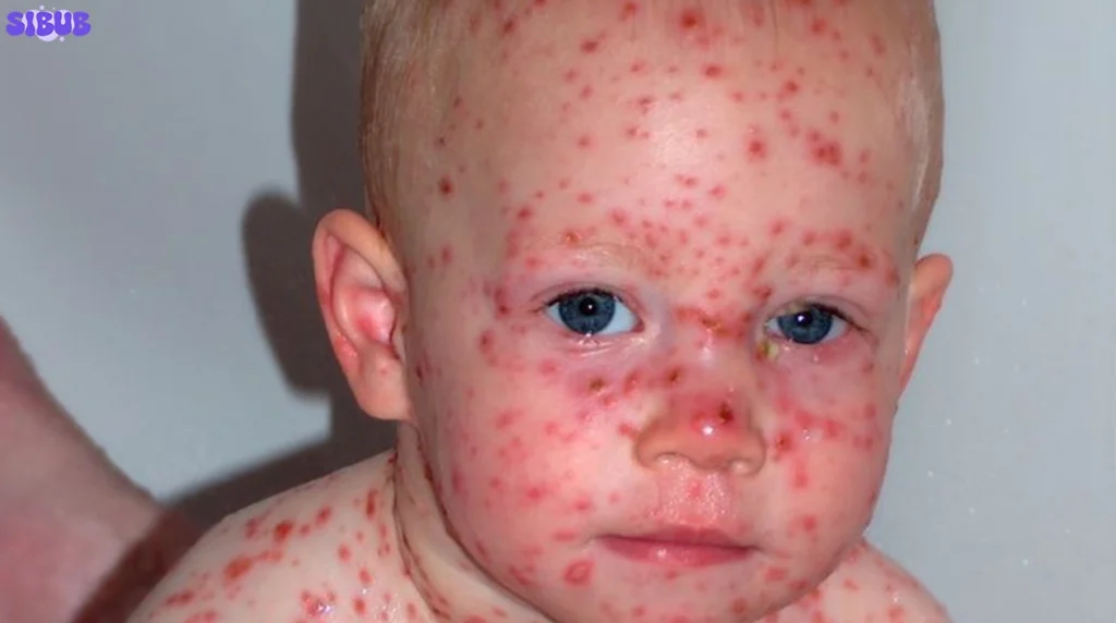Hand, Foot, Mouth Disease