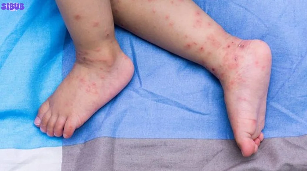 Hand, Foot, and Mouth Disease