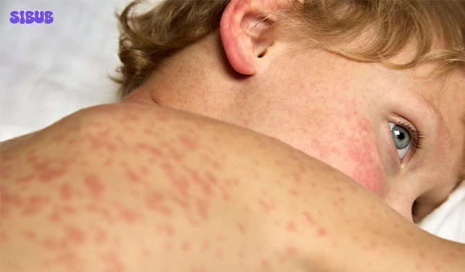amoxicillin rash