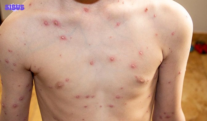 Chicken Pox Vaccine